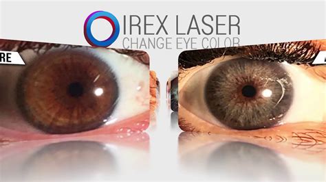 Verander oogkleur\” operatie of laser – Eye Color Change。